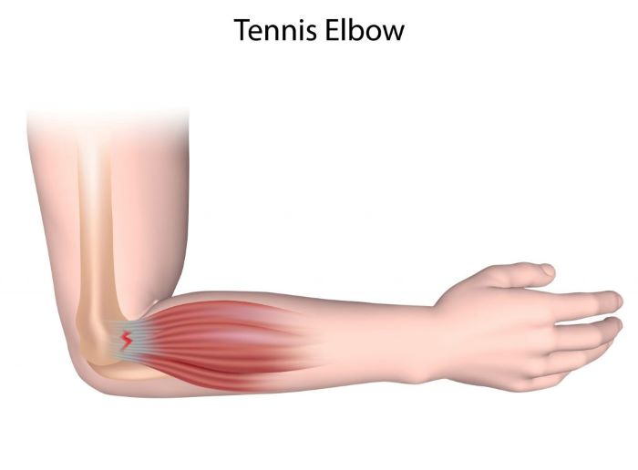 Understanding Tennis Elbow